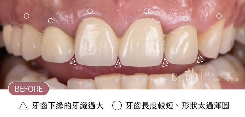 療程前王凱的前牙近照，有牙齒下緣牙縫大、牙齒較短且形狀太過渾圓等問題