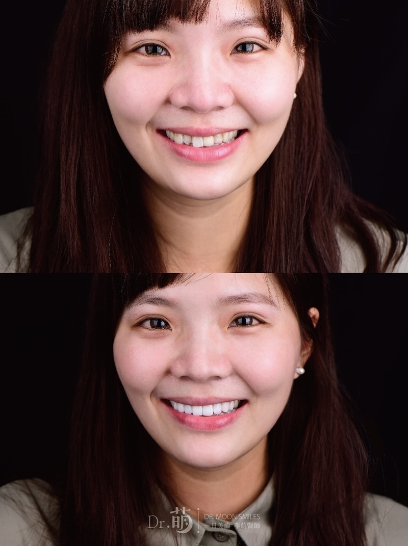 台北全瓷冠、陶瓷貼片療程前後患者笑容對比，改善排列不整、變色以及中線偏斜等問題