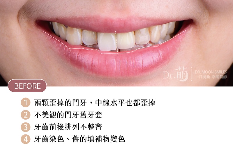 患者療程前上排牙齒近照，有牙齒不整齊、門牙歪斜、牙齒染色等問題