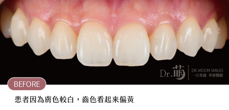 療程前患者上排牙齒近照，由於膚色較白，讓牙齒齒色看起來偏黃