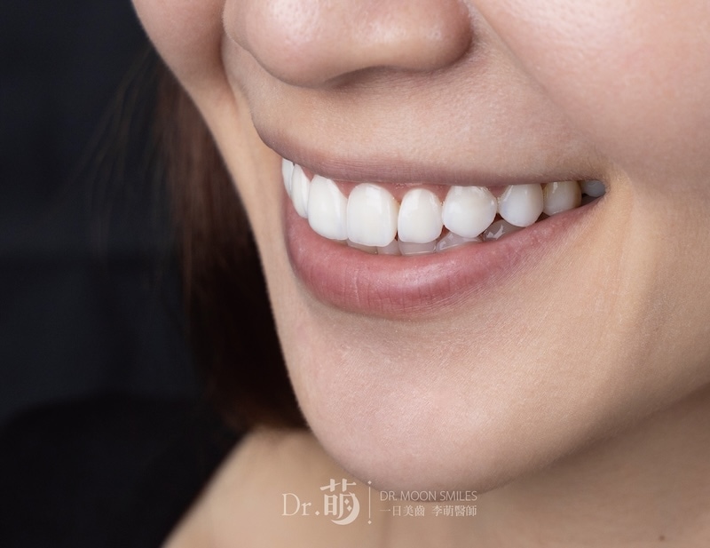 完成陶瓷貼片牙齒美白，患者的牙齒顏色變得更加白皙又自然