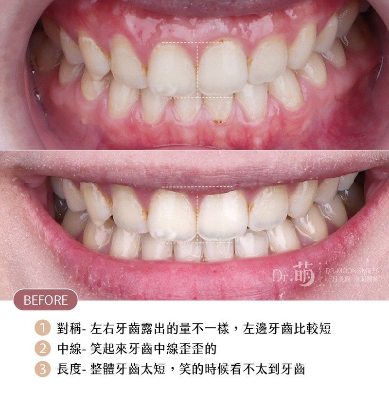 療程前牙齒近照，有排列不對稱、牙齒中線歪等問題，且整體牙齒長度偏短，笑起來看不太到牙齒