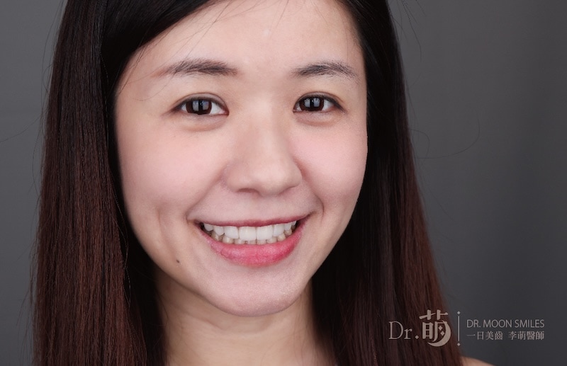 做完全口陶瓷貼片療程，患者展現自然整齊的牙齒與自信笑容