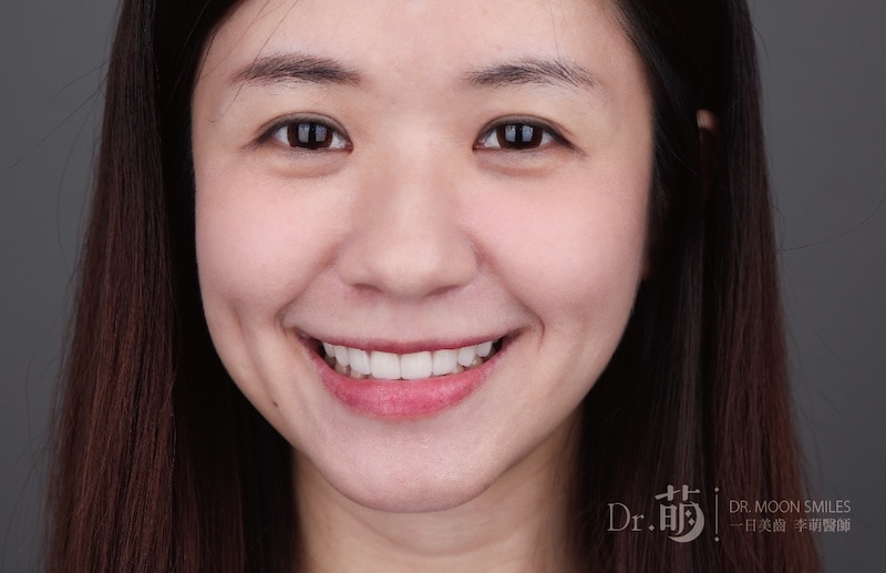 做完陶瓷貼片，患者牙齒變得更明亮飽滿，笑容更完美