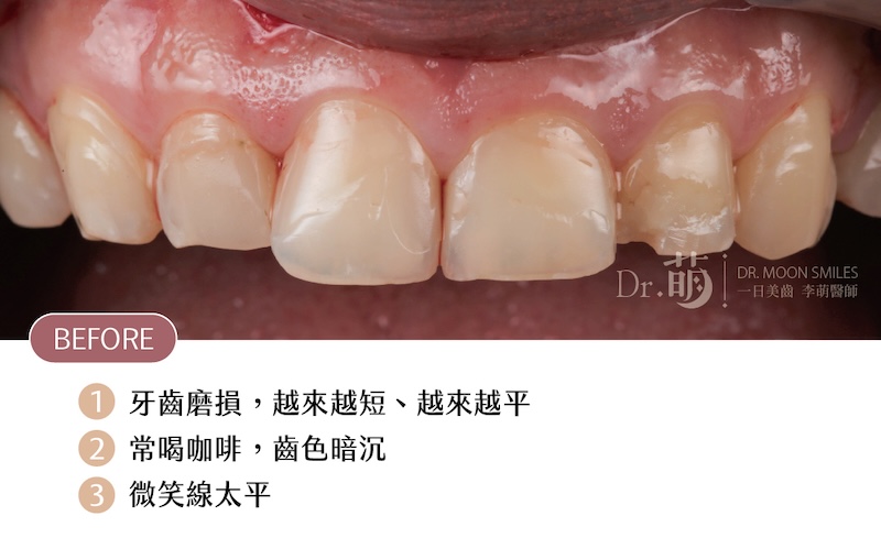 療程前牙齒近照，磨牙導致牙齒短平，伴隨牙齒黃、微笑曲線太平