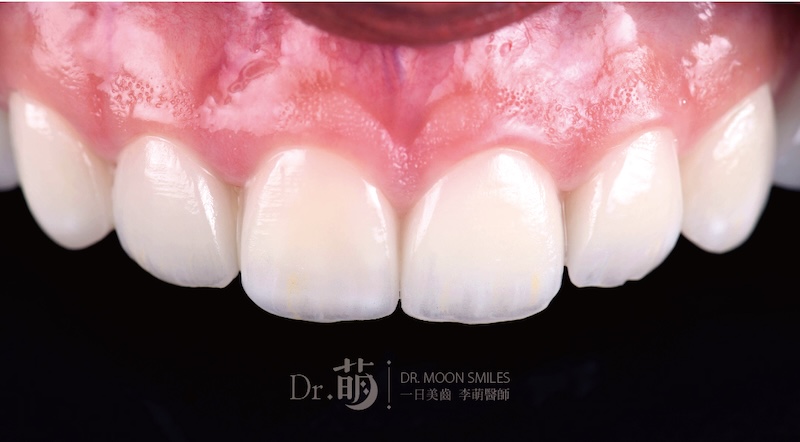陶瓷貼片上排前牙近照，外觀呈現自然、白、透的效果