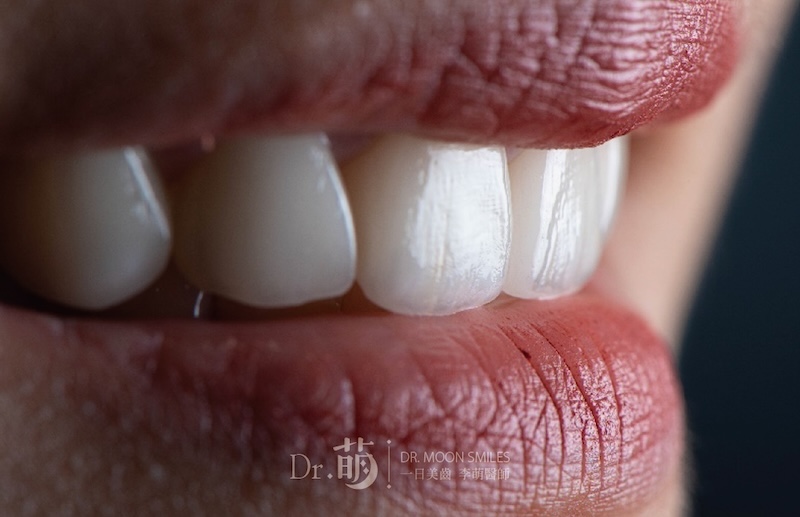 陶瓷貼片牙齒近照，白皙透亮且具有真牙自然紋理