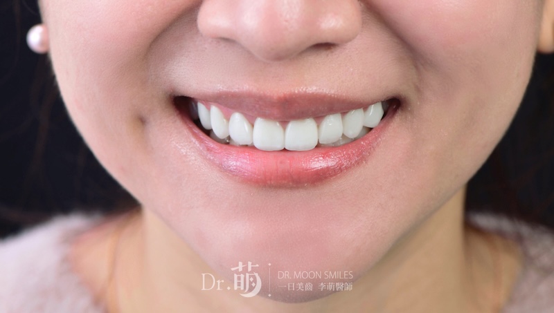 完成陶瓷貼片，患者牙齒變得白皙且圓潤飽滿，微笑曲線更美