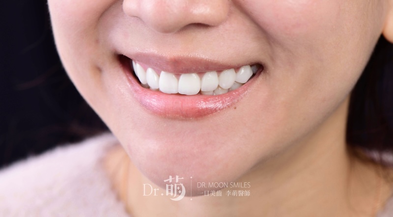 做完陶瓷貼片，患者露出零死角漂亮笑容