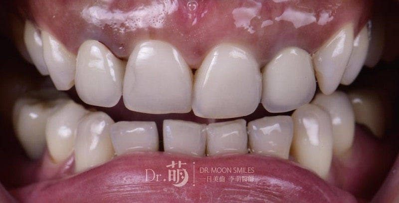 陶瓷貼片療程前牙齒狀態，可見矯正後牙齒跑掉導致排列不整齊，並伴隨牙縫黑三角及牙齒中線偏移問題